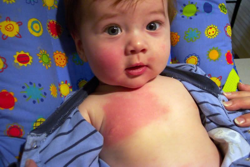 Allergic Reaction Hives. a horrible case of hives.